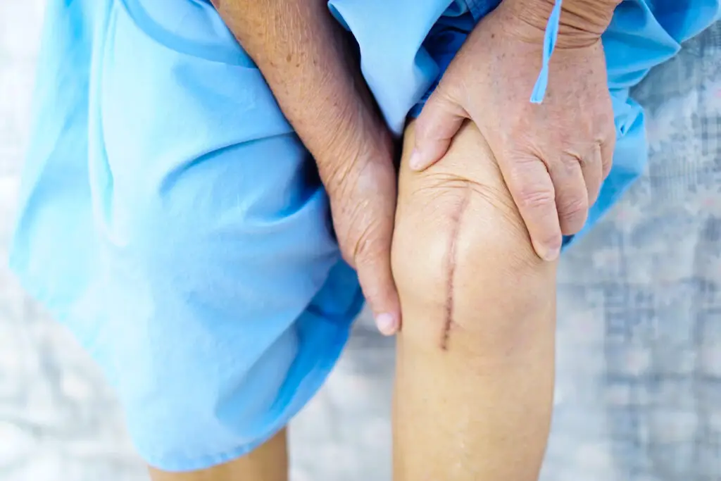 Senior or elderly old lady woman patient show her scars on knee after total knee replacement
